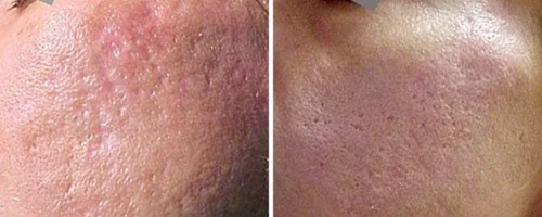 cicatriz acnes